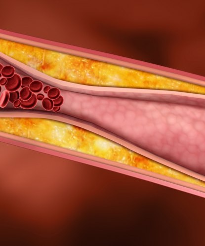 Как избавиться от холестериновых бляшек в сосудах